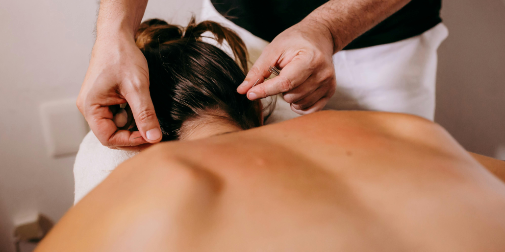 Acupuncture