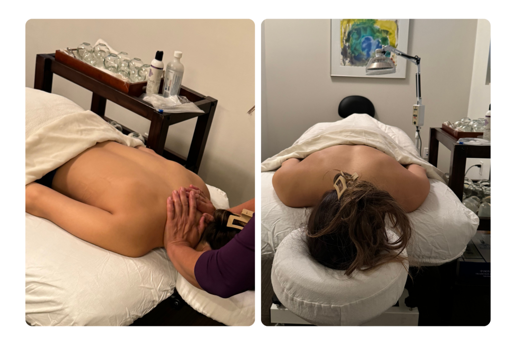 Acupuncture Acupuncture