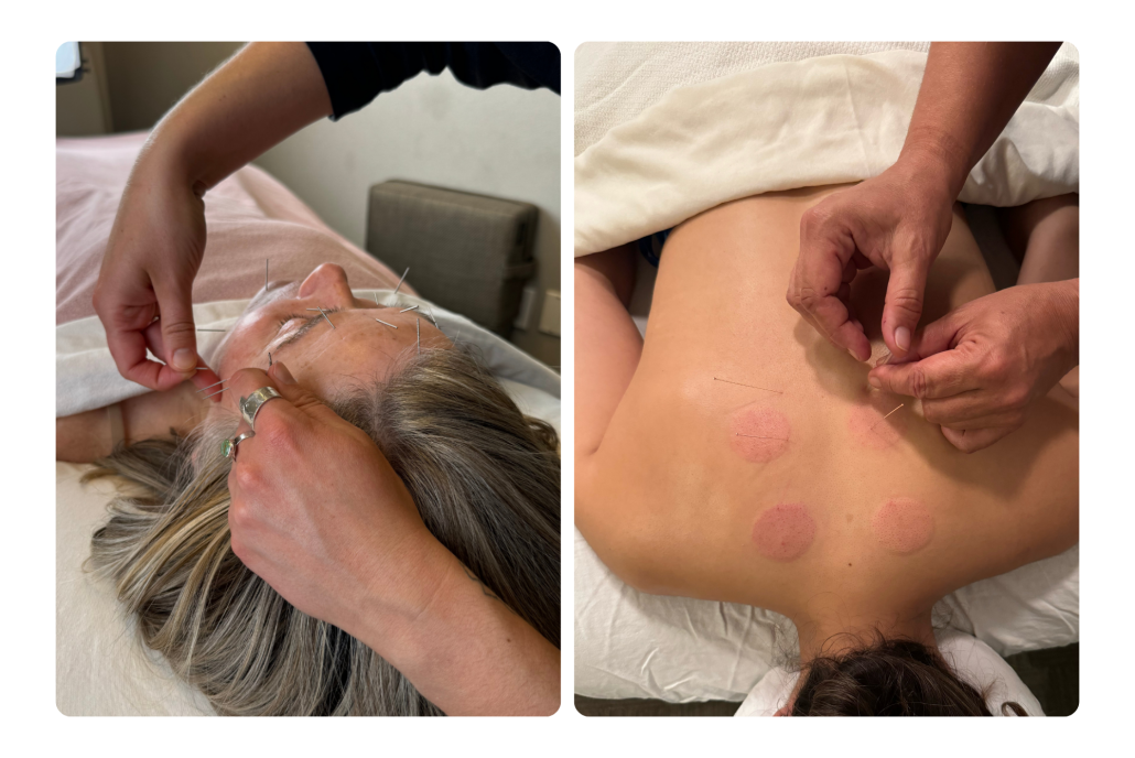 Acupuncture
